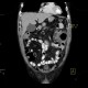 Jejunal diverticulitis, diverticulosis: CT - Computed tomography